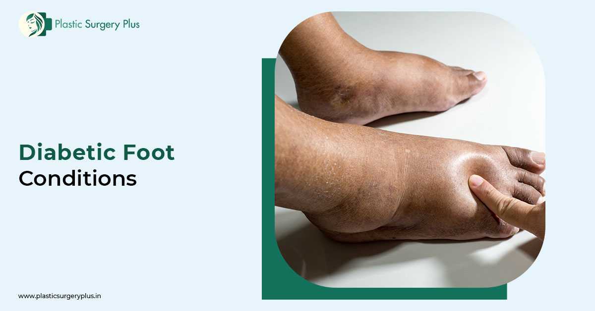 What Is Diabetic Foot? Here’s What To Know
